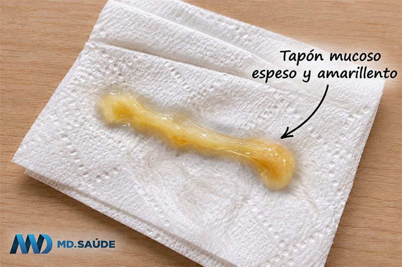 Tapón mucoso espeso y amarillento sobre papel higiénico blanco, con aspecto gelatinoso y alargado.