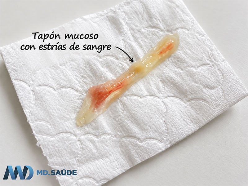 Tapón mucoso de aspecto gelatinoso, amarillento y con pequeñas estrías de sangre sobre papel higiénico.