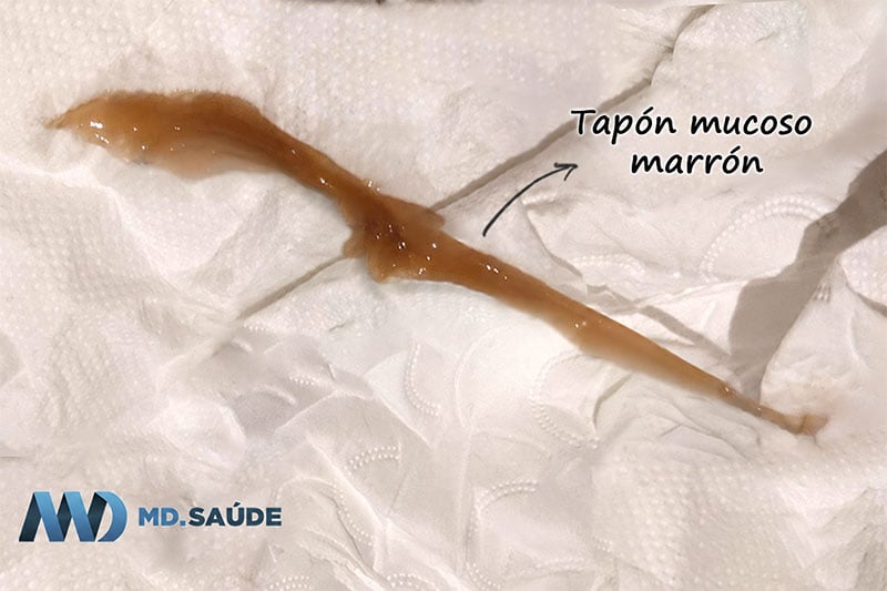 Tapón mucoso de color marrón y aspecto gelatinoso sobre papel higiénico blanco.