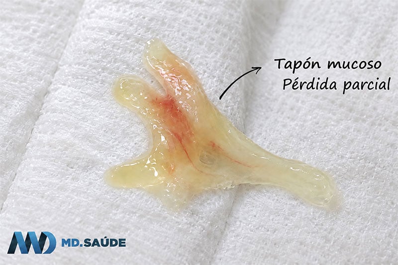 Pérdida parcial del tapón mucoso, con una pequeña cantidad de moco translúcido y discretas estrías de sangre sobre papel higiénico blanco.