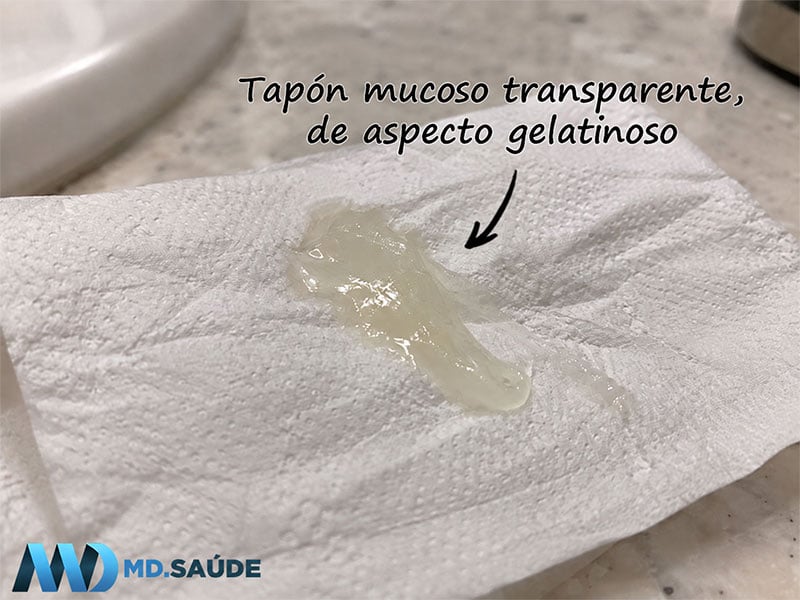 Tapón mucoso transparente, de aspecto gelatinoso, sobre papel higiénico blanco.