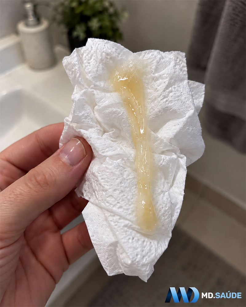 Mano sosteniendo papel higiénico con moco espeso, alargado y amarillento, de aspecto similar a la mucosidad nasal.