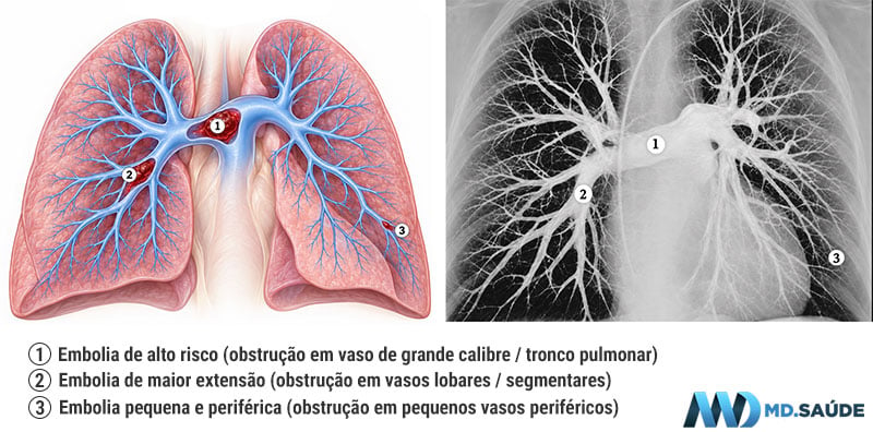 Comparação entre uma ilustração anatômica colorida e uma imagem angiográfica dos pulmões, ambas com três pontos numerados que indicam possíveis locais de obstrução por êmbolos nas artérias pulmonares.