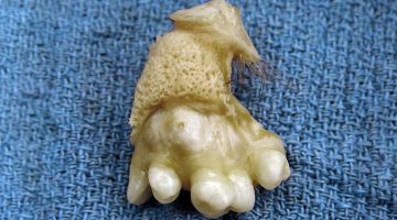 TERATOMA OVÁRICO – Tipos, Síntomas y Tratamiento