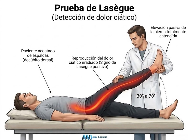 Ilustración de la prueba de Lasègue que muestra a un paciente acostado boca arriba mientras el médico eleva la pierna extendida entre 30° y 70°, reproduciendo el dolor ciático irradiado.