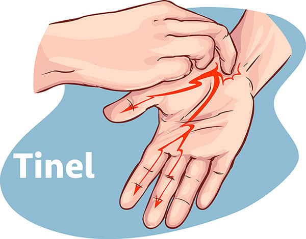 Cómo se hace la prueba del túnel carpiano? - Costa Rica