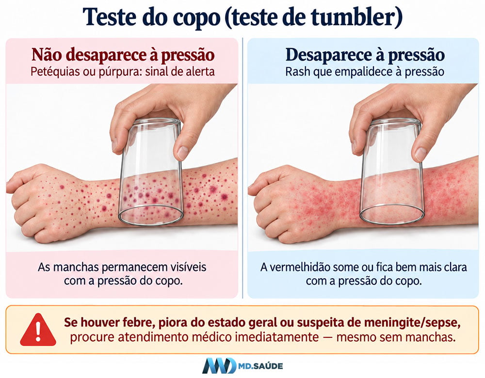 Teste de Tumbler - meningite