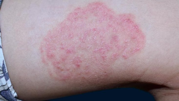 Ti a dermatofitosis Qu Es S ntomas Y Tratamiento Ti a dermatofitosis Qu Es S ntomas Y Tratamiento
