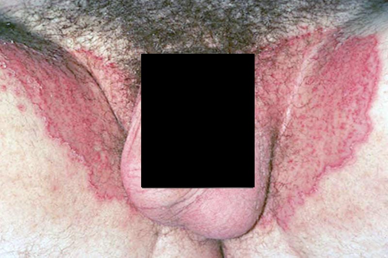 Micose de virilha no homem - Lesão nas virilhas, poupando bolsa escrotal e pênis.