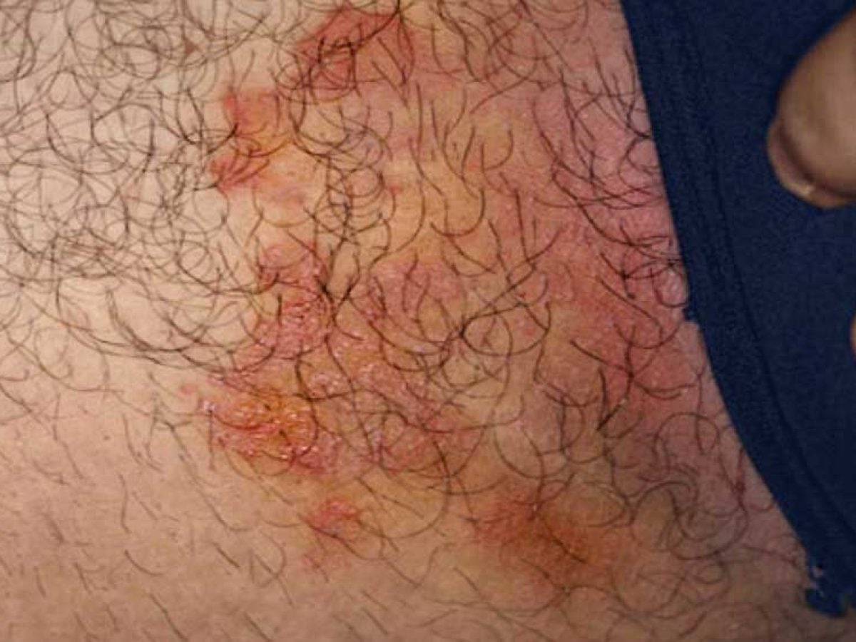 FOTOS | Micose na virilha (tinea cruris)