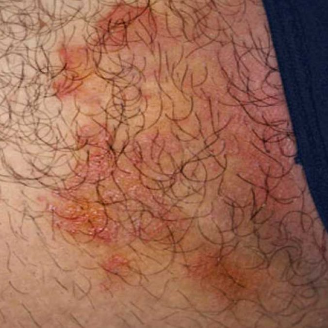 Fungal Infection Inner Thigh Fungal Infection Inner Thigh