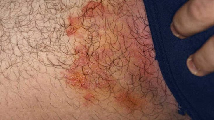 Fotos de tiña inguinal (tinea cruris)