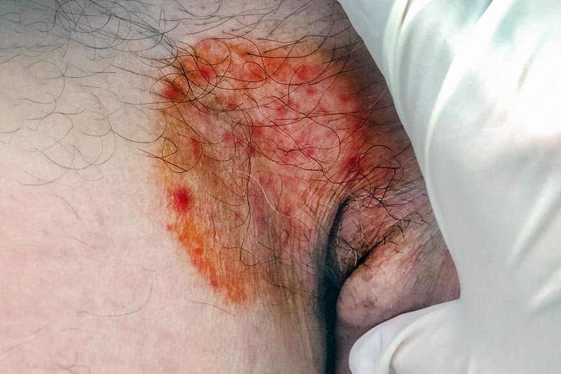 Tinea Cruris (prurido Jock) - Distúrbios dermatológicos - Manuais