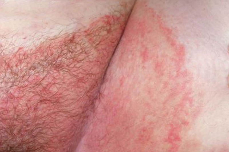 Fungal Infection Called Tinea Corporis in Leg. Widespread Ringworm Over  Knee Area Stock Photo - Image of dermatitis, lesion: 229678202