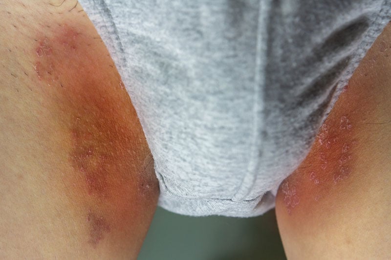 ❇A tinea cruris, também conhecida como micose da virilha, é uma infeção por  fungo extremamente comum. É uma infecção fúngica que acomete a região