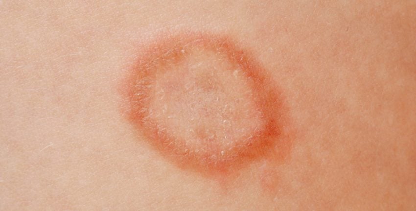 Camaragibe Agora - 🔴 Como identificar e tratar a Impingem A impingem,  conhecida cientificamente como Tinea corporis, é doença de pele causada por  fungos, que provoca o surgimento de pequenas vesículas de