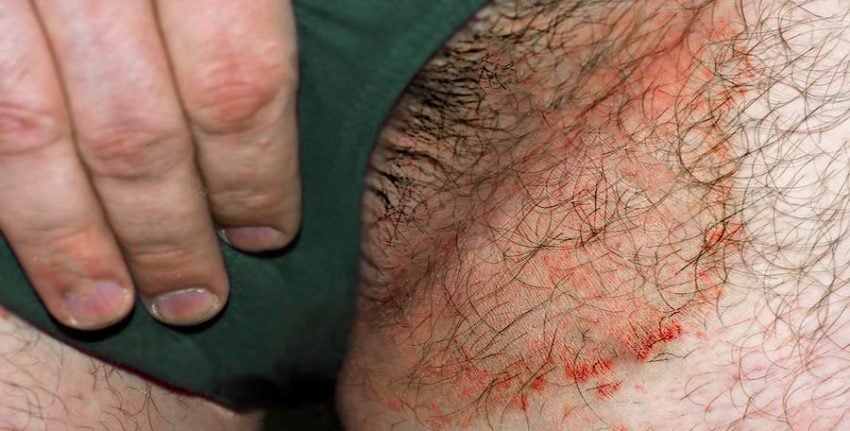 Tínea cruris, lesão avermelhada na virilha