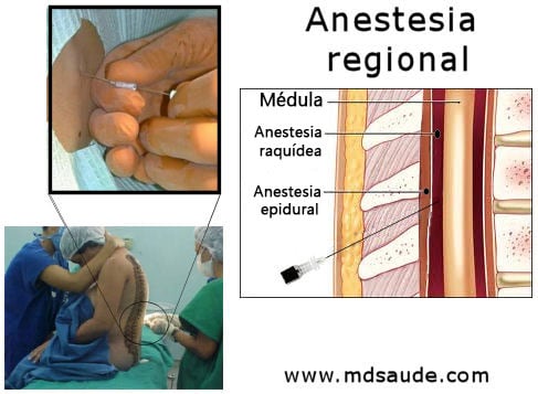 Anestesia raquídea y epidural