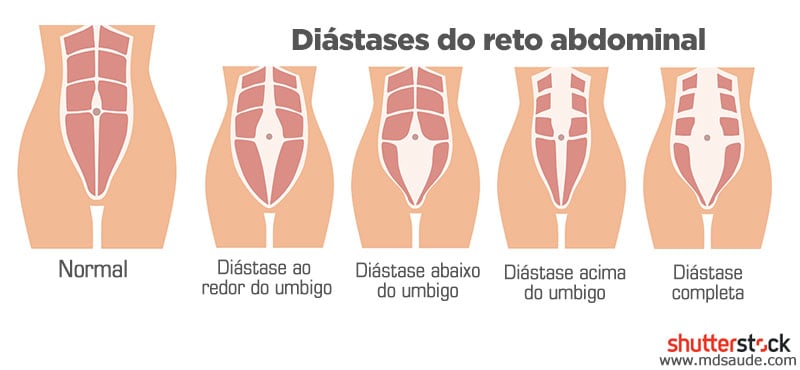 maiellyalves - A diástase se dá de vários tipos: 1- Diástase