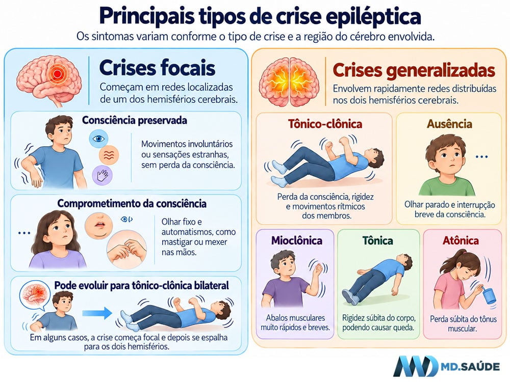 Infográfico mostrando os principais tipos de crise epiléptica, com exemplos de crises focais e generalizadas, incluindo ausência, mioclônica, tônica, atônica e tônico-clônica.