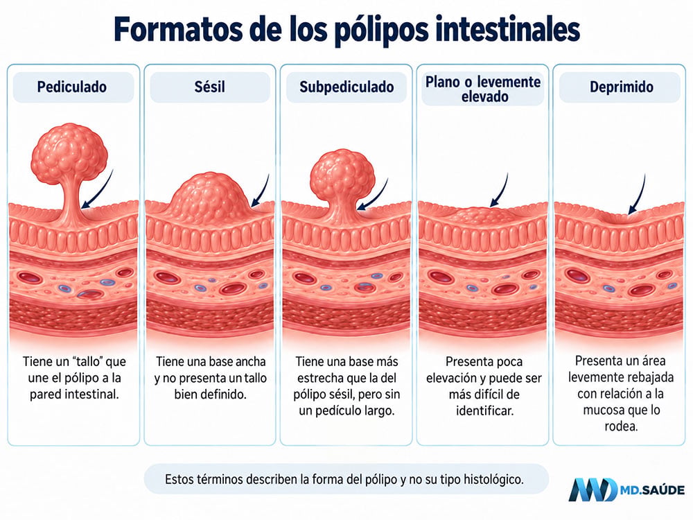 Principales formas de los pólipos intestinales observadas durante la colonoscopia: