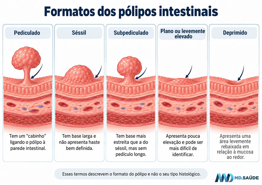 Principais formatos dos pólipos intestinais observados durante a colonoscopia:
