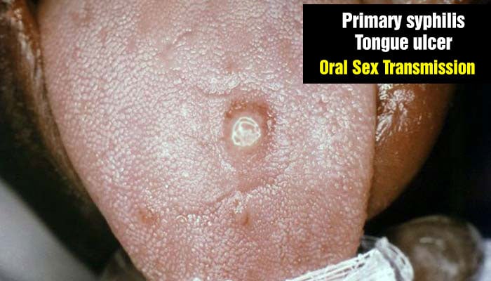 Tongue ulcer - Primary syphilis acquired by oral sex