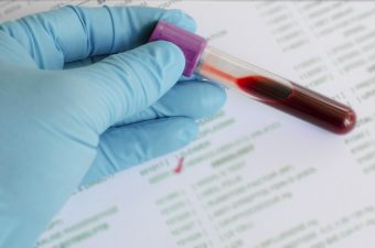 EXAMES DO FÍGADO – TGO, TGP, gama GT e bilirrubinas