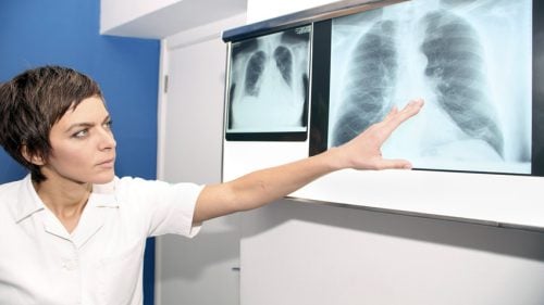 Embolia pulmonar: qué es, síntomas, causas y tratamiento
