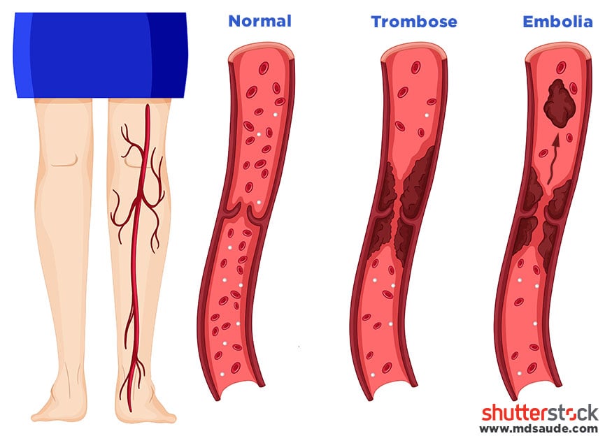 Embolia e trombose