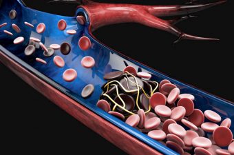 Trombosis Venosa Profunda: Causas, Signos y Tratamiento