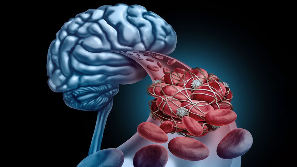 Trombose cerebral