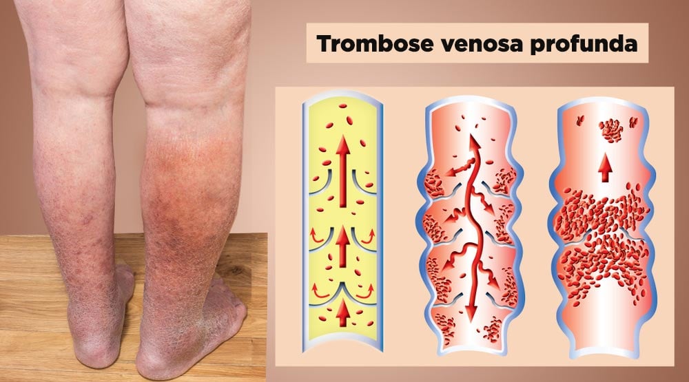 Trombose venosa profunda