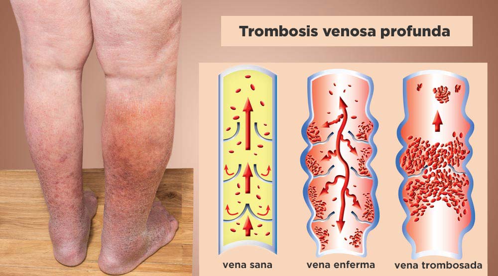 Trombosis Venosa Profunda Qu Es S Ntomas Y Tratamiento Md Sa De