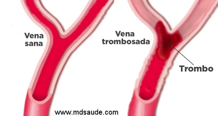 Trombosis venosa