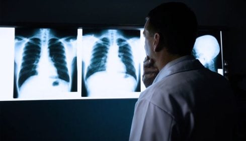 Diferencias entre neumonía y tuberculosis