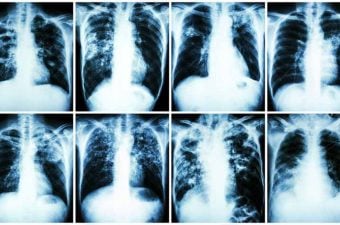 TUBERCULOSIS – Causas, síntomas y tratamiento
