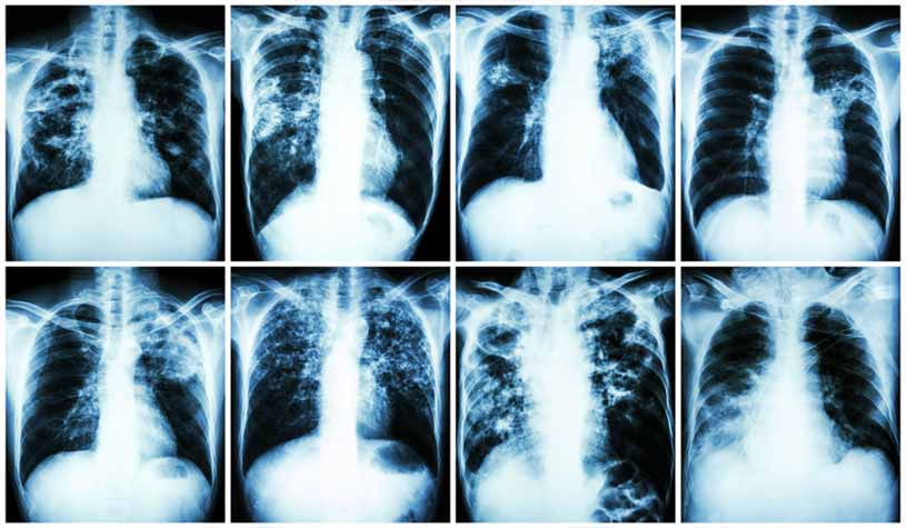 tuberculosis