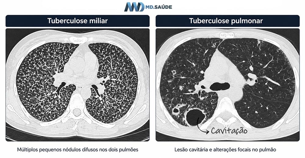 Ilustração de uma tomografia computadorizada com imagens de tuberculose miliar e tuberculose pulmonar cavitária
