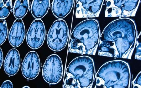 6 síntomas de tumor cerebral