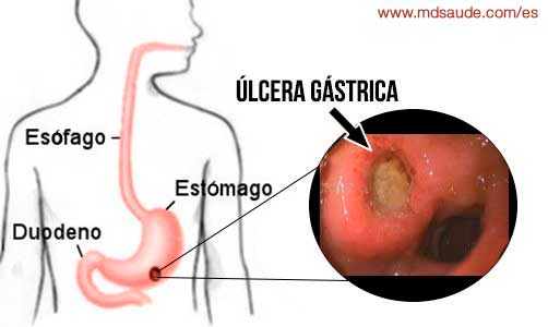 úlcera gástrica
