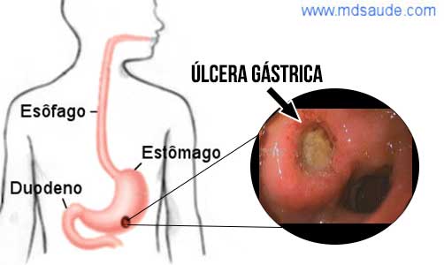 Úlcera no estômago