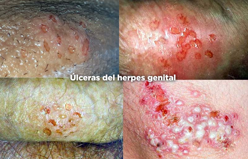 Etapa de las úlceras herpéticas genitales