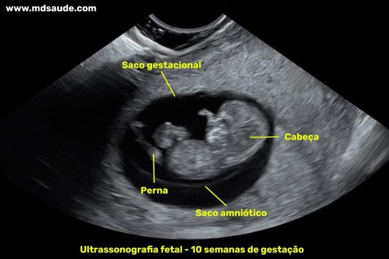 10 semanas de gravidez | Gestação semana a semana