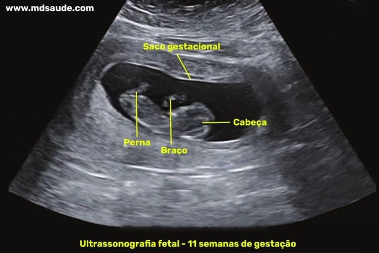 11 semanas de gravidez | Gestação semana a semana