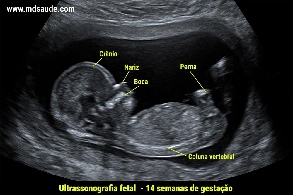 Ultrassom com 14 semanas de gravidez