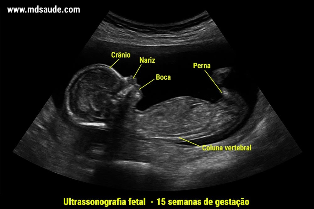 Ultrassom com 15 semanas de gravidez