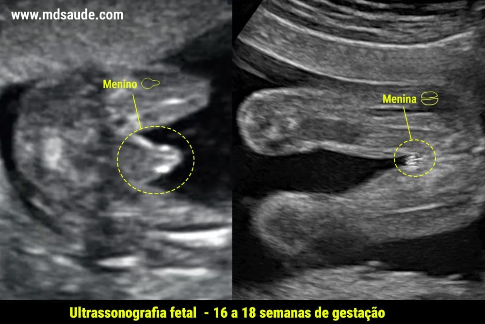 Identificação do sexo do bebê através da ultrassonografia.