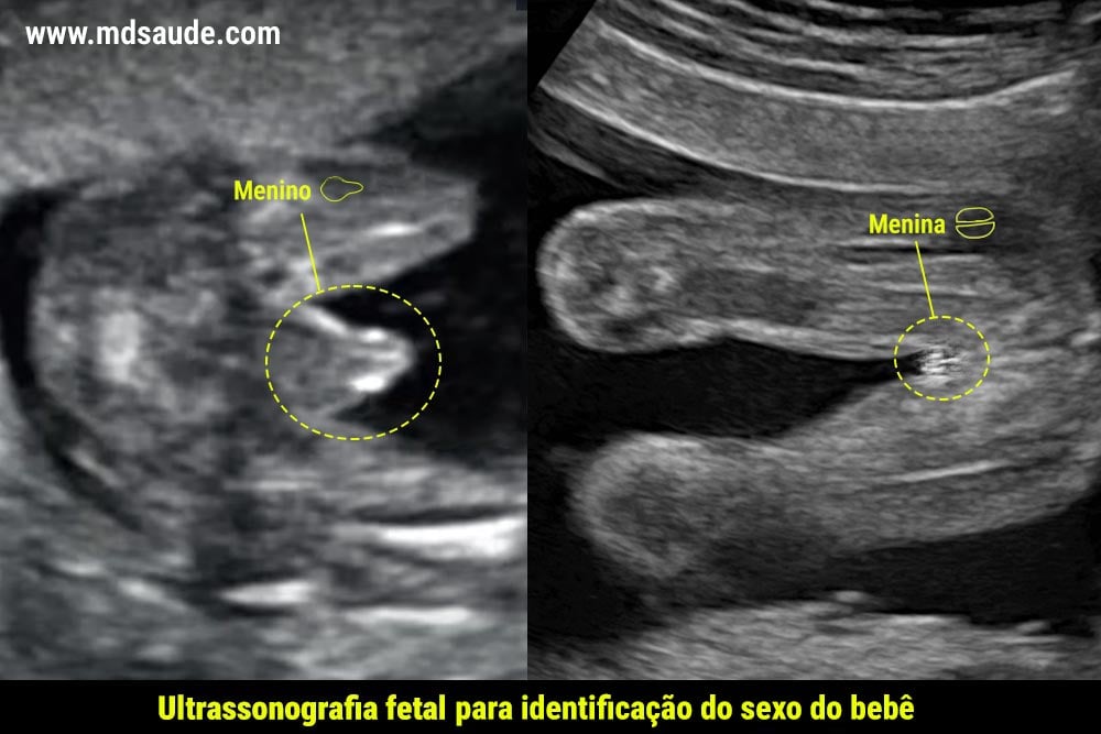 Identificação do sexo do bebê através da ultrassonografia.