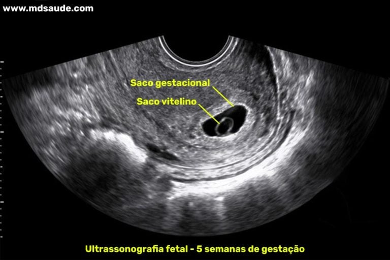 5 semanas de gravidez | Gestação semana a semana